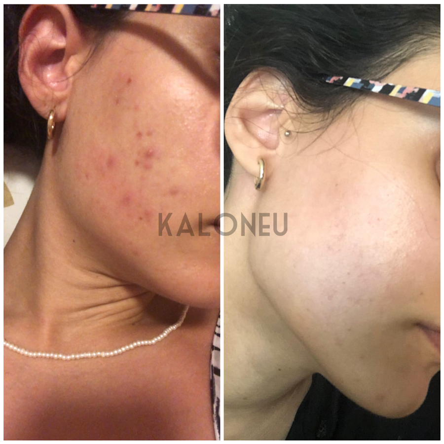 Kaloneu Acne & Scarring Skin Care Bundle | 100% Organic - Kaloneu